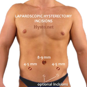 Laparoscopic Hysterectomy incisions