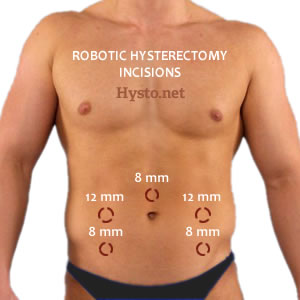 Laparoscopic Hysterectomy incisions.