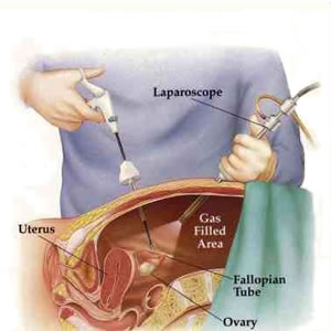 Laparoscopic Hysterectomy: Total Vaginally-Assisted Laparoscopic Hysterectomy