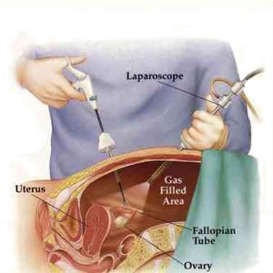 laparoscopic hysterectomy before and after